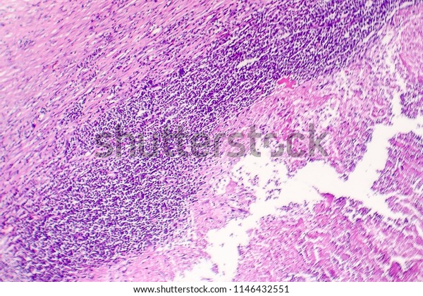 Pericarditis Inflammation Heart Pericardium Light Micrograph Stock ...