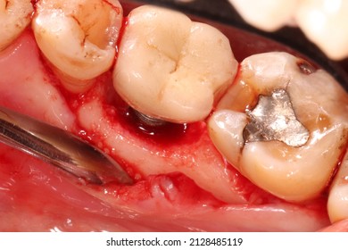 Peri-implantitis : Diseases that cause loss of bone around the dental implant, we can see the screw expose and gingival recession
