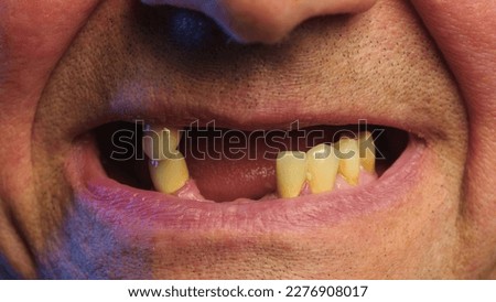 Periodontal disease and missing teeth in an elderly man. Close up shot of a toothless male mouth. Man showing his rotten teeth, caries, decayed and weak enamel, teeth falling out, dental problems