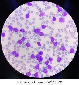 Peripheral Blood Smear Of Chronic Lymphocytic Leukemia Or CLL Patient, Lymphocyte And Blast Cell