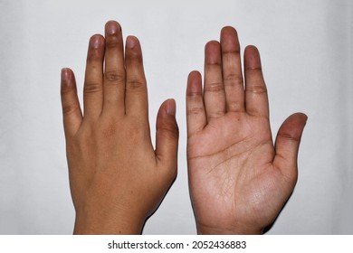 Peripheral Cyanosis Or Blue Hands At Southeast Asian, Chinese Young Woman With Congenital Heart Disease.