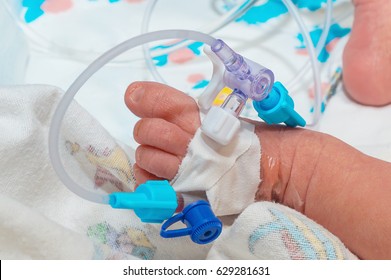 Peripheral Intravenous Catheter Or IV Cannula With Tee Stopcock Adapter With Connector Device In The Vein Of A Newborn Baby Foot In Neonatal Intensive Care Unit At Children's Hospital