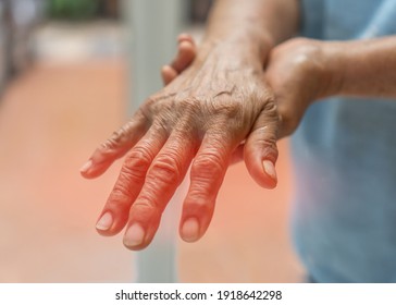 Peripheral Neuropathy pain in elderly senipatient on hand, palm, finger and sensory nerves with numb, aching, muscle weakness, stabbing, burning from chronic inflammatory demyelinating polyneuropathy