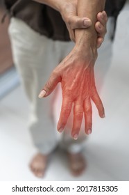 Peripheral Neuropathy Pain, Guillain-Barre Syndrome GBS In Elderly Patient On Hand, Finger And Sensory Nerves With Numb, Aching, Muscle Weakness From Chronic Inflammatory Demyelinating Polyneuropathy