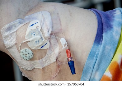 Peripherally Inserted Central Catheter Better Known As A PICC Line