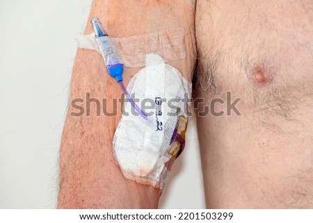 Peripherally inserted central catheter in a mans arm