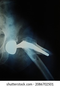 Periprosthetic Fracture Of A Hem Hip Arthroplasty