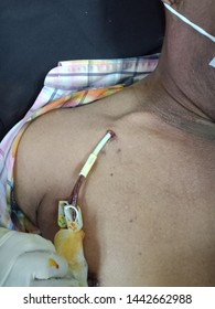 Permanent Catheter For Dialysis Has Infections