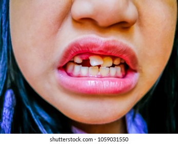 Permanent Milk Teeth On Child One Stock Photo 1059031550 | Shutterstock