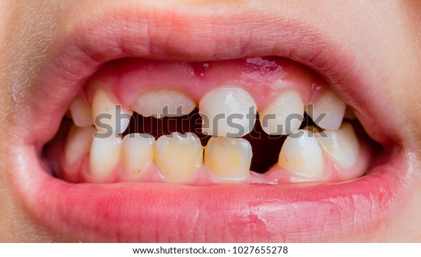 Permanent Milk Teeth On Child One Stock Photo Edit Now 1027655278