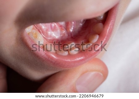 A permanent molar in a child grows second row. Incorrect growth of molars or polyodontia in dentistry.