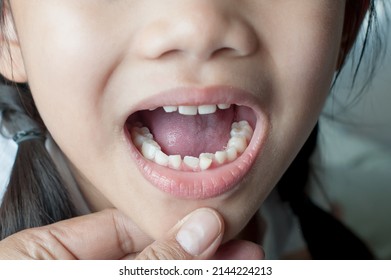 Permanent Teeth That Are Coming Up In Place Of Milk Teeth.