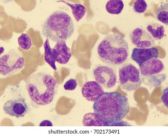 Pernicious Anemia (giant Band And Myelocyte)