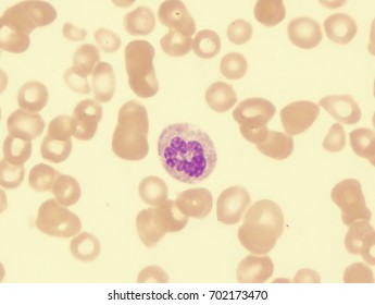 77 Pernicious anemia Images, Stock Photos & Vectors | Shutterstock