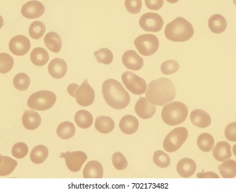 Pernicious Anemia (macro Ovalocytes)