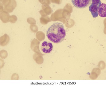 Pernicious Anemia (normal Band And Giant Metamyelocyte)