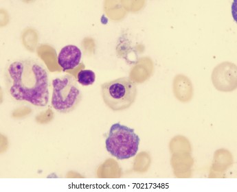 Pernicious Anemia (orthochromatic Megaloblast With Howell-Jolly Bodies)