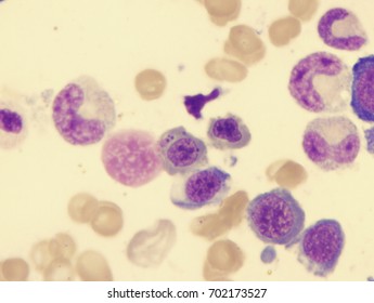 Pernicious Anemia (orthochromatic Megaloblast With Multiple Howell-Jolly Bodies)