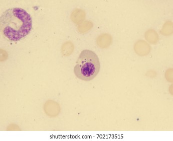 Pernicious Anemia (orthochromatic Megaloblastic With Multiple Howell-Jolly Bodies)