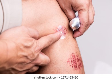 Person Applying White Antiseptic Cream Onto Painful Wound From Abrasive Fall