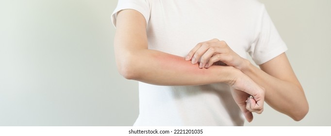 Person Have Red Rash On Arm From Insect Bite Allergic.