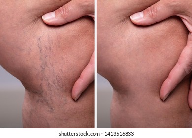 A Person Knee's With Varicose Veins And Capillaries Before And After Medical Treatment
