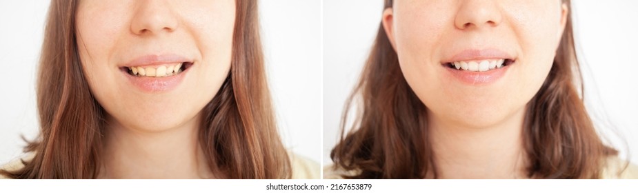 Person Smiles, Shows Teeth, Yellow Plaque, Crooked Teeth, Malocclusion. Before And After Bleach Whitening.