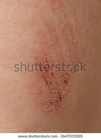 A person's arm has a red mark on it. The mark is small and he is a burn