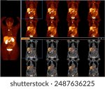 Pet bt ct scan or nuclear scan image of a patient showing normal skeleton of the whole body, Positron Emission Tomography or PET CT Scan of Human Body