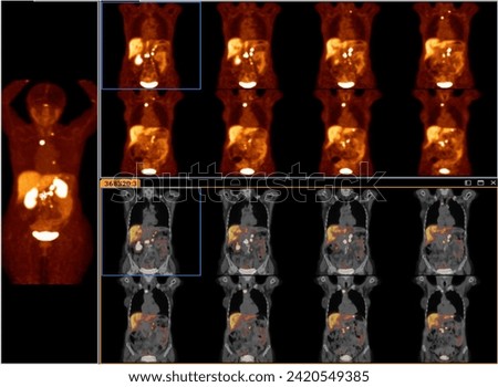 Pet bt ct scan or nuclear scan image of a patient showing normal skeleton of the whole body, Positron Emission Tomography or PET CT Scan of Human Body	