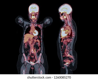 PET CT Scan Fusion Image Of Whole Human Body Coronal And Sagittal Plane For Detect Cancer Recurrence After Surgery. 