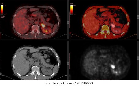 PET CT scan of Human Body (Positron Emission Tomography)  Many Other Radiological Images (CT, MRI, PET CT, X-ray) in my portfolio