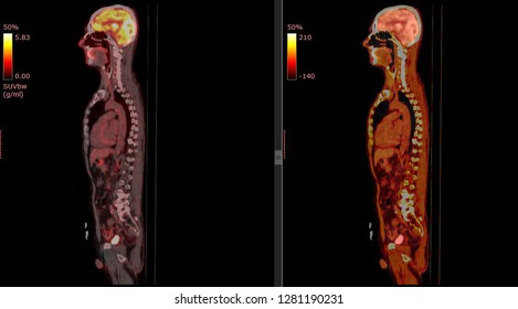 PET CT Scan Of Human Body (Sagittal View Positron Emission Tomography)  High Resolution