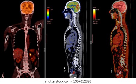 PET CT Scan Of Human Body ( Positron Emission Tomography)