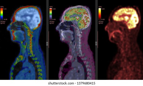 PET CT Scan Of Human Brain (Positron Emission Tomography) 