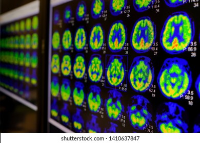 PET CT Scan Of Human Brain (Axial View Positron Emission Tomography)