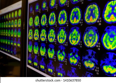 PET CT Scan Of Human Brain (Axial View Positron Emission Tomography)