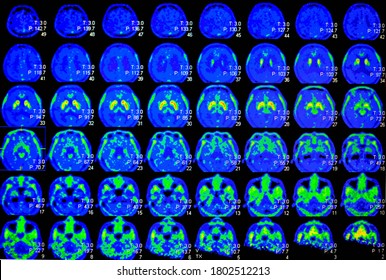 PET CT Scan Of Human Brain (Axial View Positron Emission Tomography)