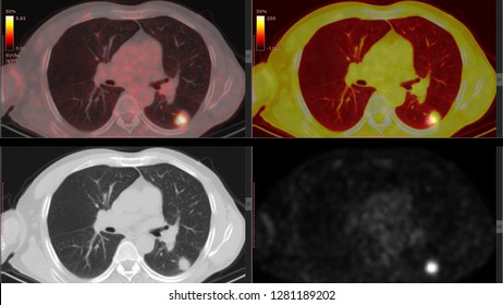 PET CT Scan Of Lung (High Resolution) Many Other Radiological Images (CT, MRI, PET CT, X-ray) In My Portfolio