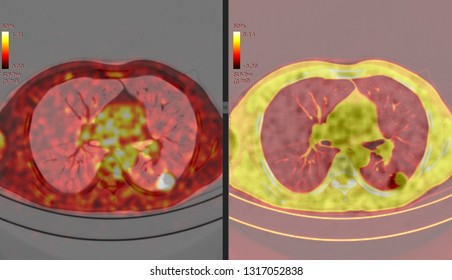 PET CT Scan Of Lung ( Positron Emission Tomography)  Many Other Radiological Images (CT, MRI, PET CT, X-ray) In My Portfolio) 