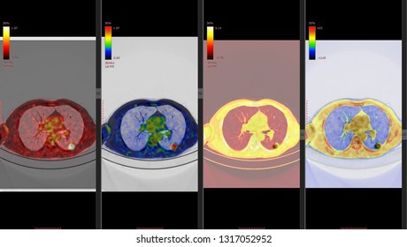 PET CT Scan Of Lung ( Positron Emission Tomography)  Many Other Radiological Images (CT, MRI, PET CT, X-ray) In My Portfolio) 