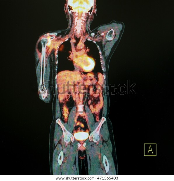 PET Scan of body\
Anterior Posterior View