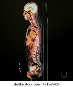 PET Scan Of Body Lateral View