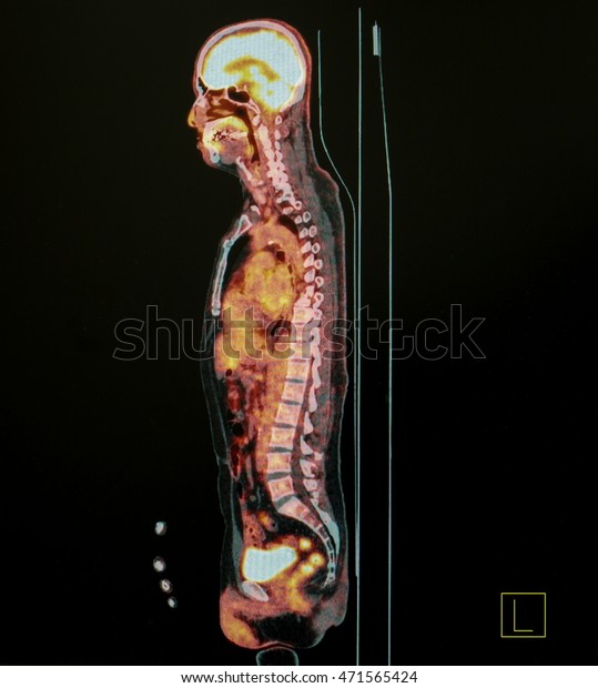 PET Scan of body Lateral\
View