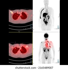 PET Scan Image Of Thorax Or Chest  Comparison Axial , Coronal  For Detect Lung Cancer Recurrence After Surgery. Medical Technology Concept.