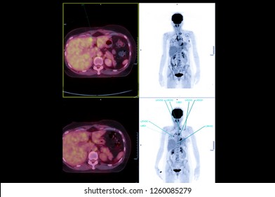 PET Scan Image Of Whole Body Comparison Axial , Coronal  Plane In Patient Liver Cancer Recurrence Treatment By PET CT