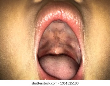 Petechiae On Soft Palate And Red Pharynx, This Is A Physical Findings In Streptococcal Pharyngitis.