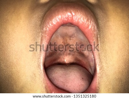 Petechiae on soft palate and red pharynx, This is a physical findings in Streptococcal pharyngitis.
