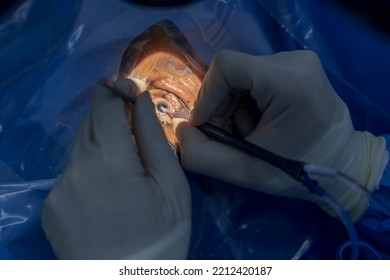 Phacoemulsification, Destruction Of The Opaque Lens By Microscope, Ophthalmic Eye Surgery. Eye Lens Replacement, Intraocular Lens Installation,surgical Cataract Treatment.Close Up Photo In Blue Tone.