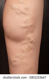 Phlebeurysm, Varicose Veins Of The Lower Extremities Close-up, Peripheral Vascular Disease.